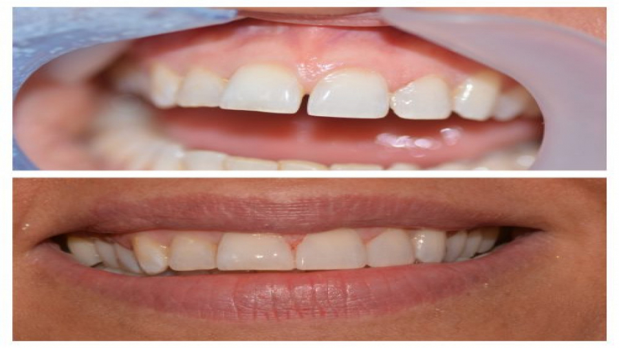 فیلم مراحل درمان کامپوزیت ونیر دندان برای بستن فاصله بین دندان ها بیماری بهجت