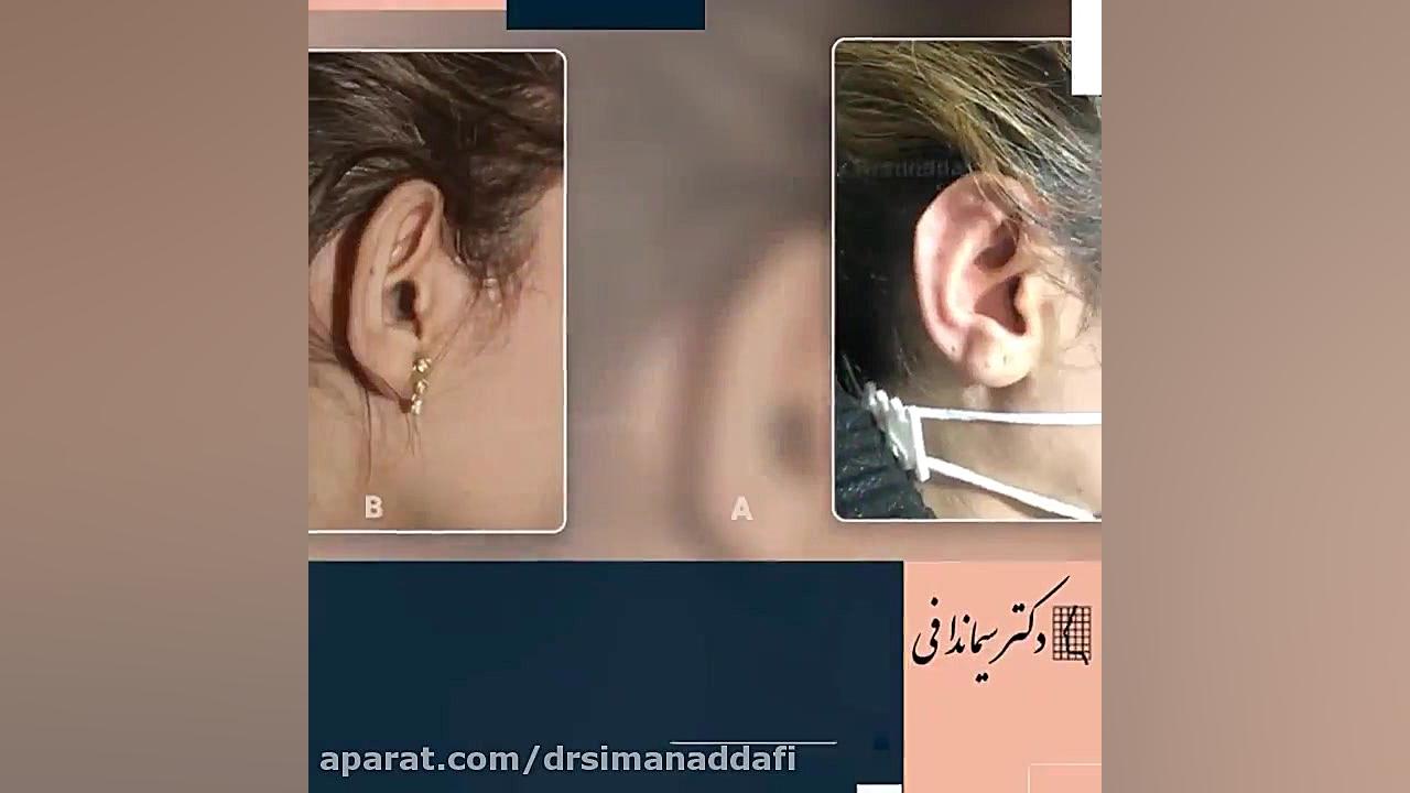 جراحی زیبایی گوش توسط دکتر ندافی هیدروراکس