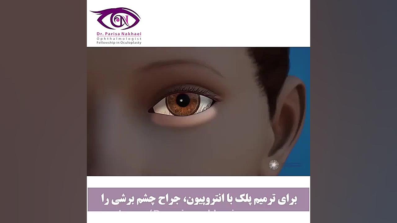 جراحی انتروپیون Axon Guidance Study