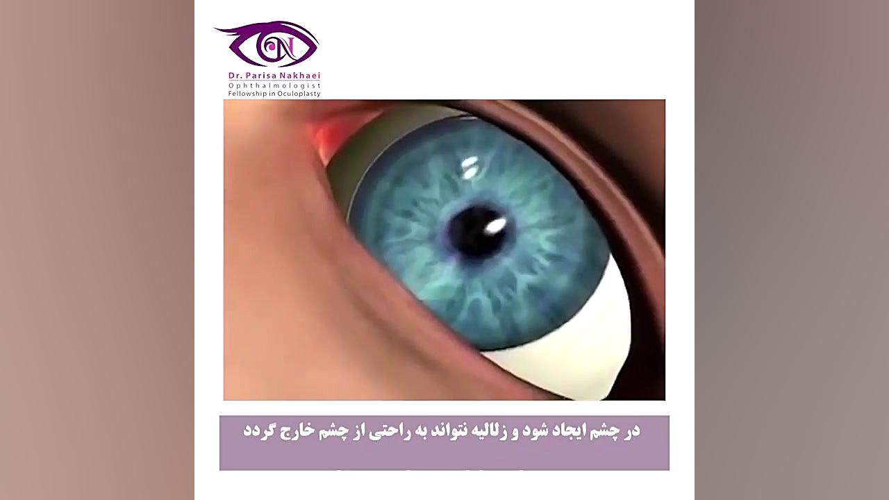 آب سیاه یا گلوکوم بلیچینگ دندان