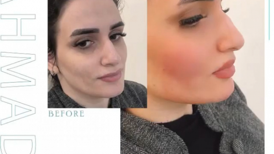 فرم دهی و زاویه سازی صورت با تزریق چربی دکتر سوسن احمدی پیر شهید