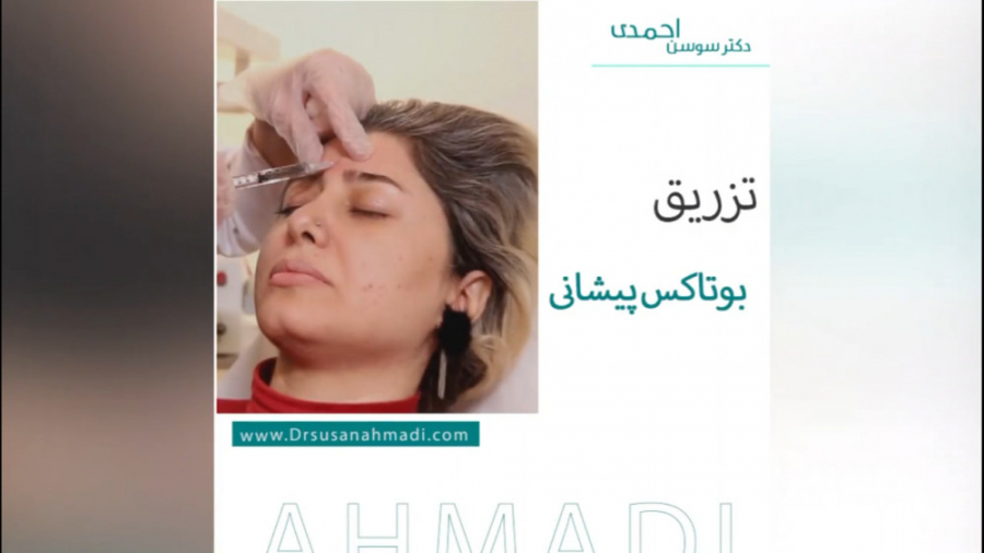 فیلم واقعی تزریق بوتاکس پیشانی️ دکتر سوسن احمدی پیر شهید