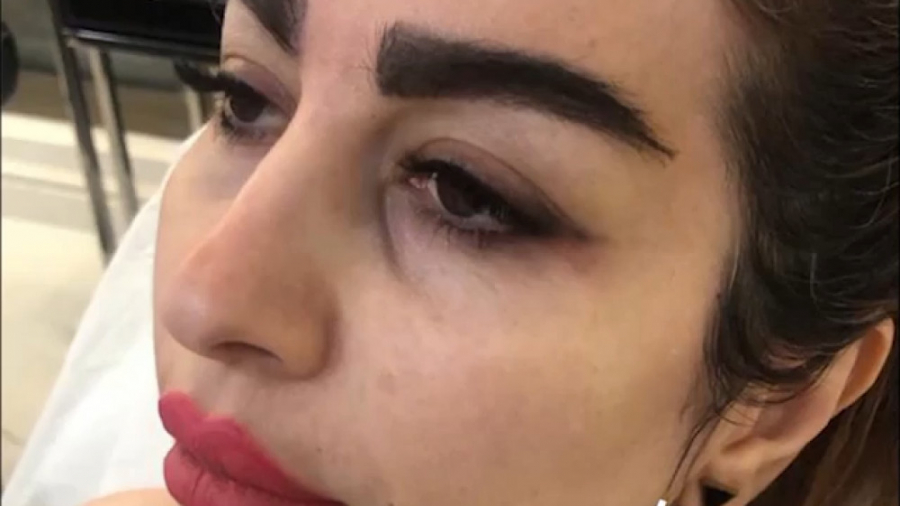 زاویه سازی صورت با تزریق چربی دکتر سوسن احمدی پیر شهید