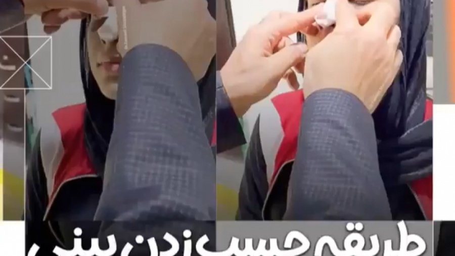 نحوه چسب زدن بینی بعد از جراحی دکتر اسماعیل شیرزادگان