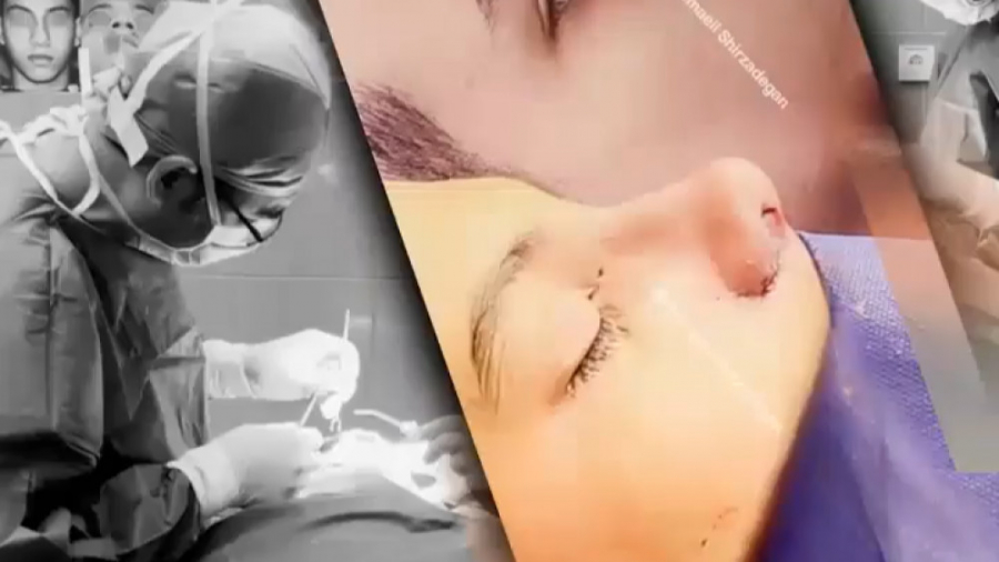 جراحی بینی دارای انحراف دکتر اسماعیل شیرزادگان
