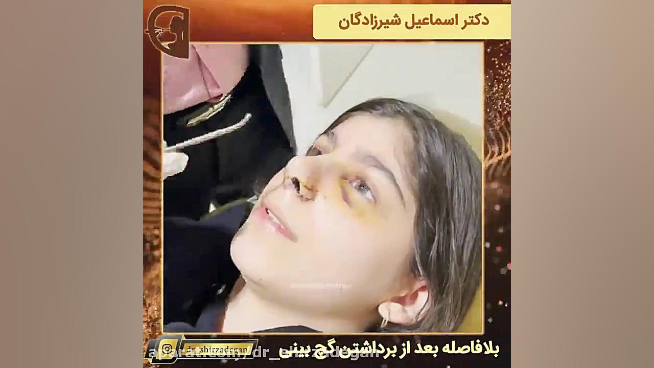 بلافاصله بعد از برداشتن گچ بینی دکتر اسماعیل شیرزادگان