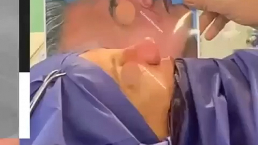 بلافاصله بعد از جراحی بینی گوشتی دکتر اسماعیل شیرزادگان