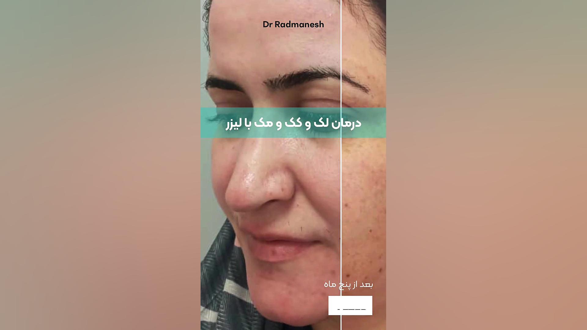 درمان لک و کک و مک با لیزر کلینیک لیزر