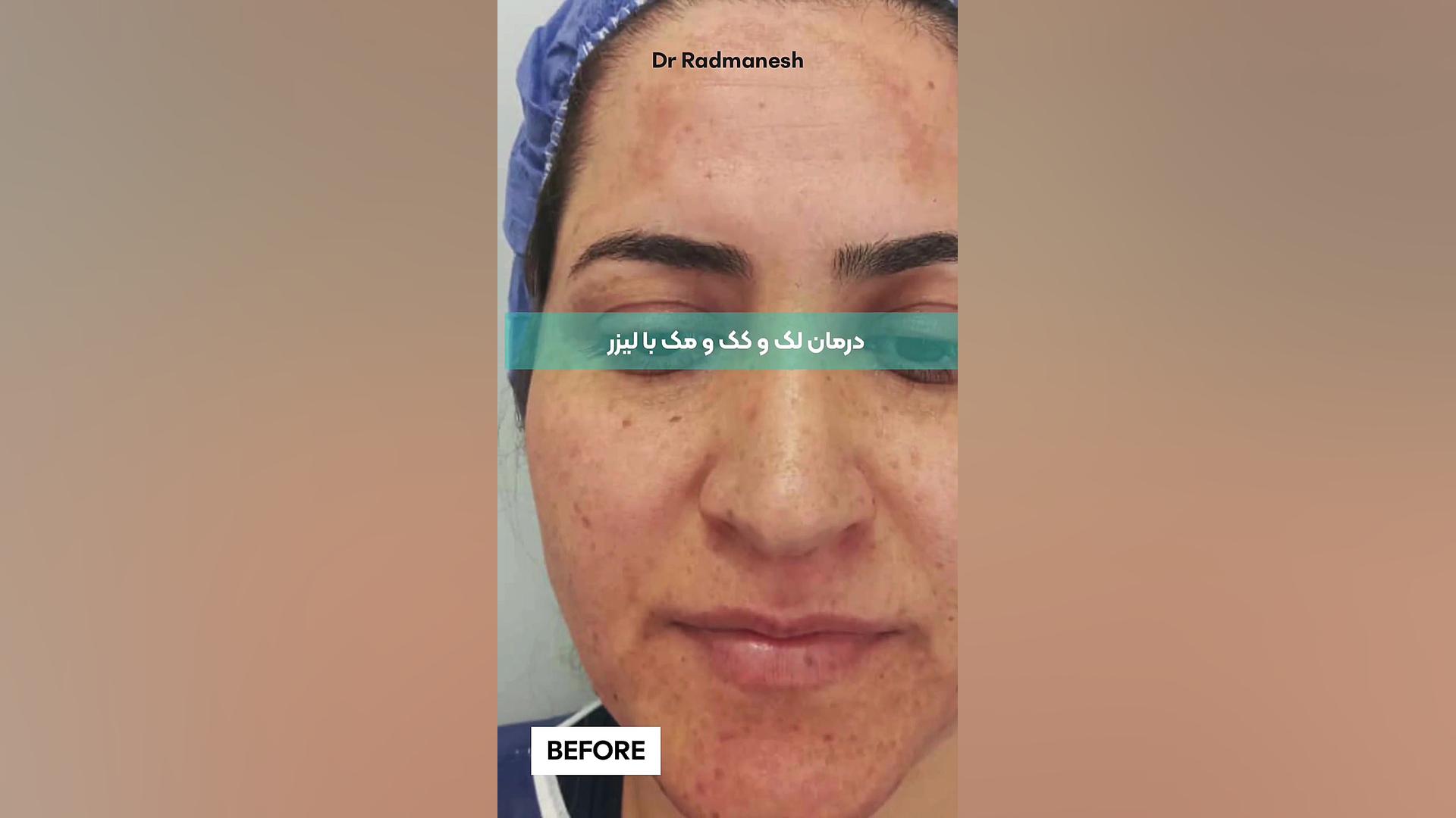 درمان لک و کک و مک با لیزر پروتز سینه