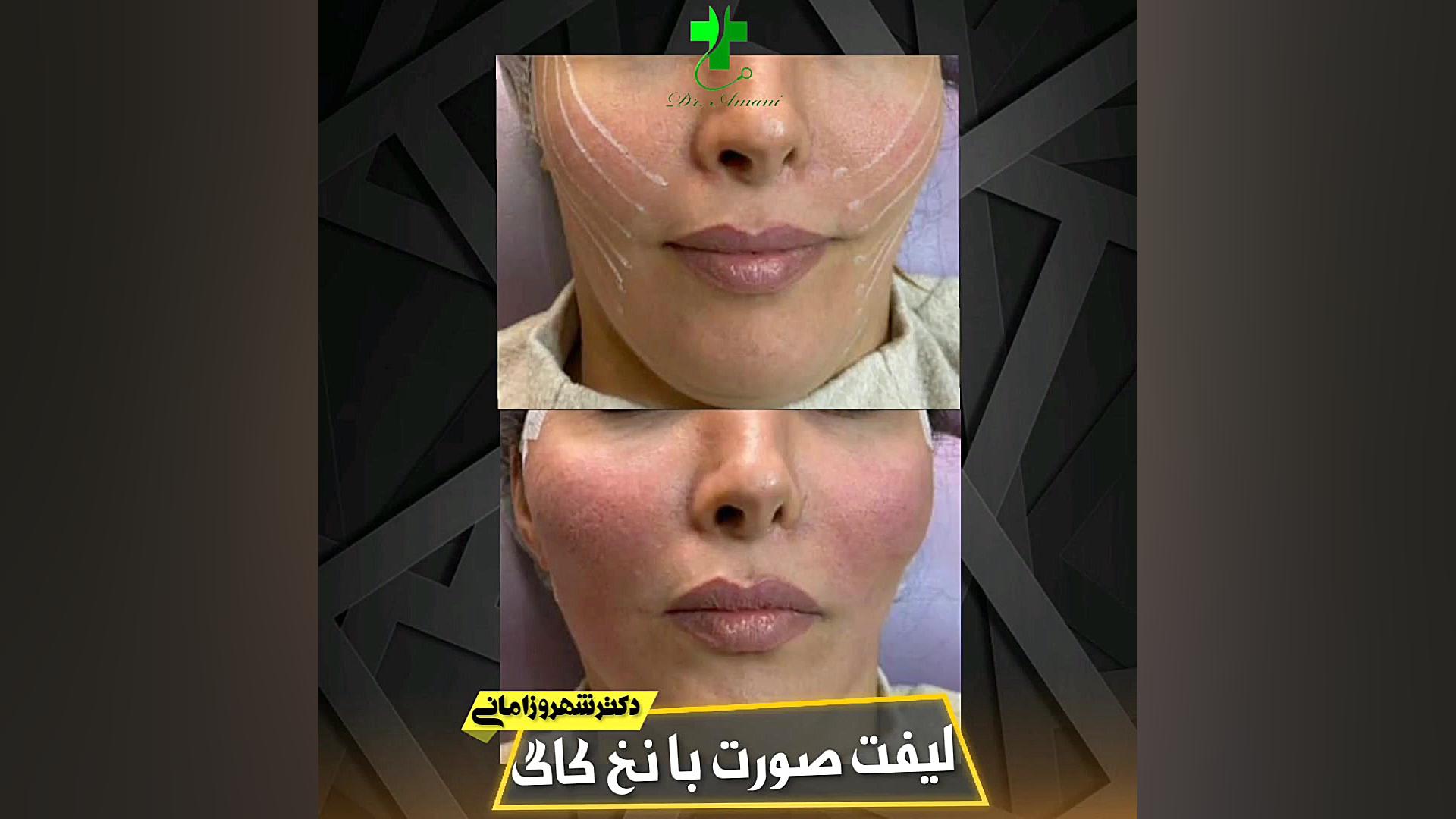 لیفت صورت با نخ کاگ پوشش زخم هیدروکلوییدی