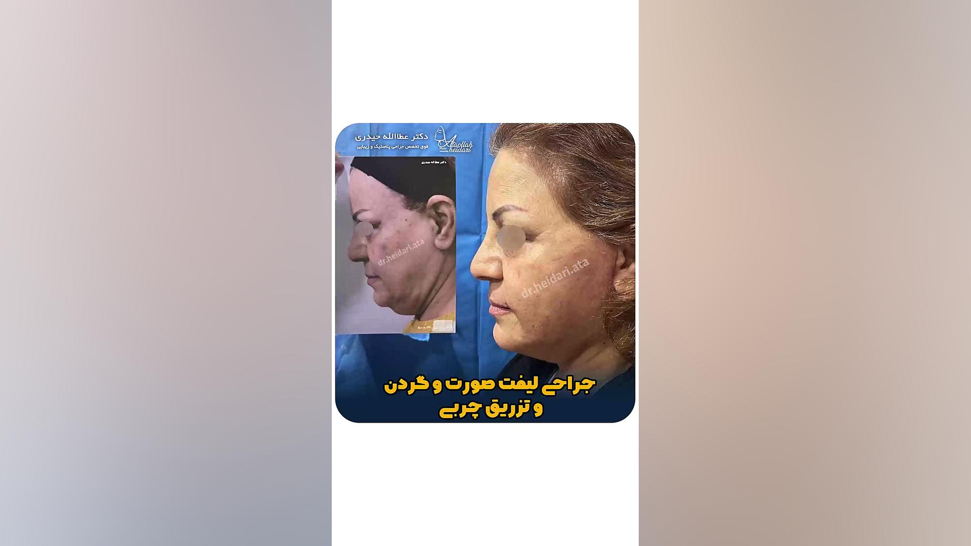 جراحی لیفت صورت و گردن و تزریق چربی دستگاه آنالیز اگزوزوم