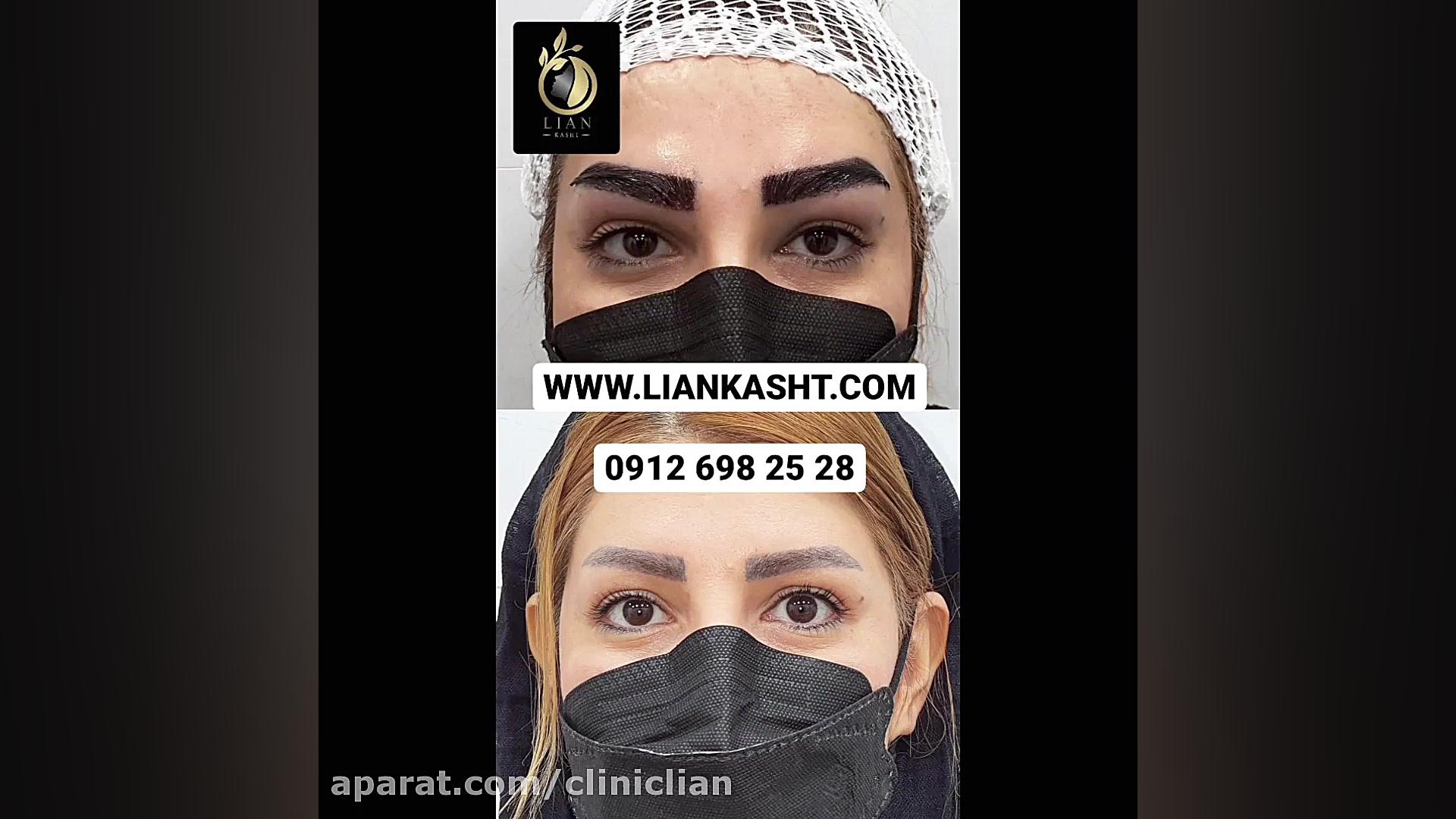 کاشت ابرو 30 ( مرکز تخصصی کاشت مو / ابرو لیان ) پرمترکسد