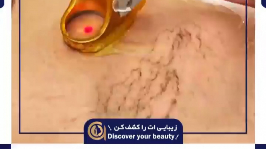 لیزر الکساندرایت کوترا برای رگهای واریسی دکتر بهزاد انوش|متخصص و جراح پوست مو زیبایی و لیزر