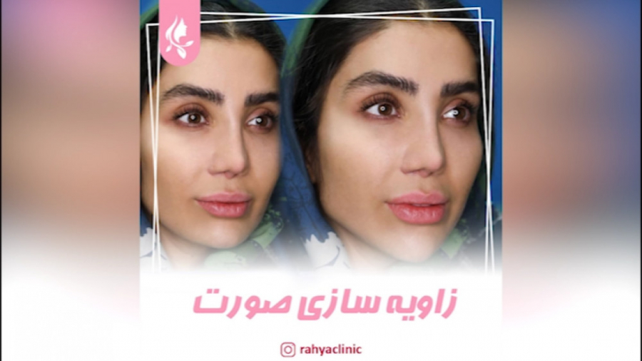 زاویه‌سازی صورت با تزریق فیلر سندرم نفروتیک ارثی