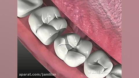 تشکیل پوسیدگی و اموزش بهداشت دکتر عبدالرضا جمیلیان - متخصص ارتودنسی