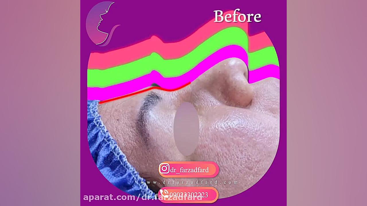 جراحی بینی گوشتی دکتر اسماعیل فرزاد فرد - فوق تخصص پلاستیک
