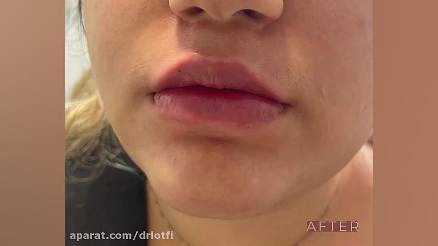 تزریق فیلر لب دکتر سار ا لطفی
