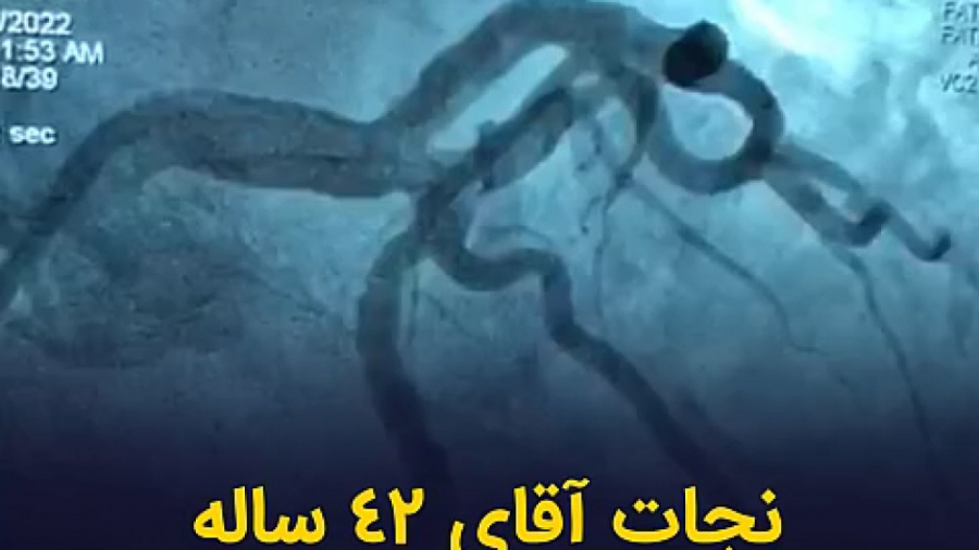 نجات آقاي ٤٢ ساله از سكته قلبي زاویه سازی صورت