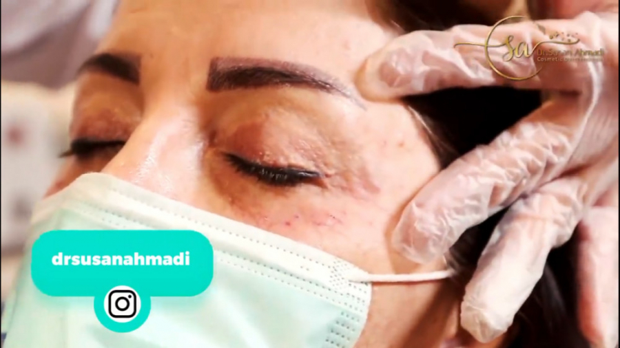 فیلم واقعی از ️تزریق تخصصی فیلر دور چشم️ دکتر سوسن احمدی پیر شهید