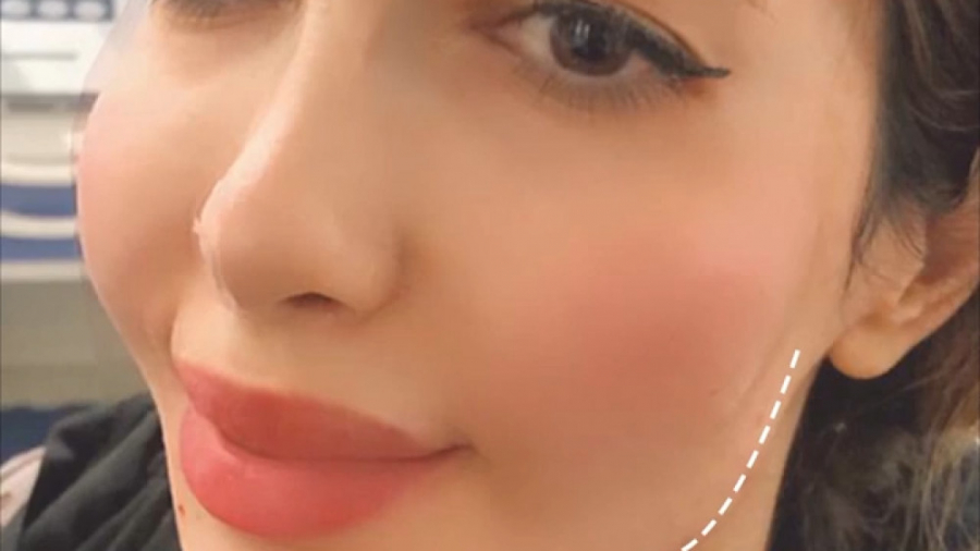 زاویه فک و صورت با تزریق چربی دکتر سوسن احمدی پیر شهید