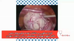 لاپاراسکوپی برداشتن توده و فیب...
