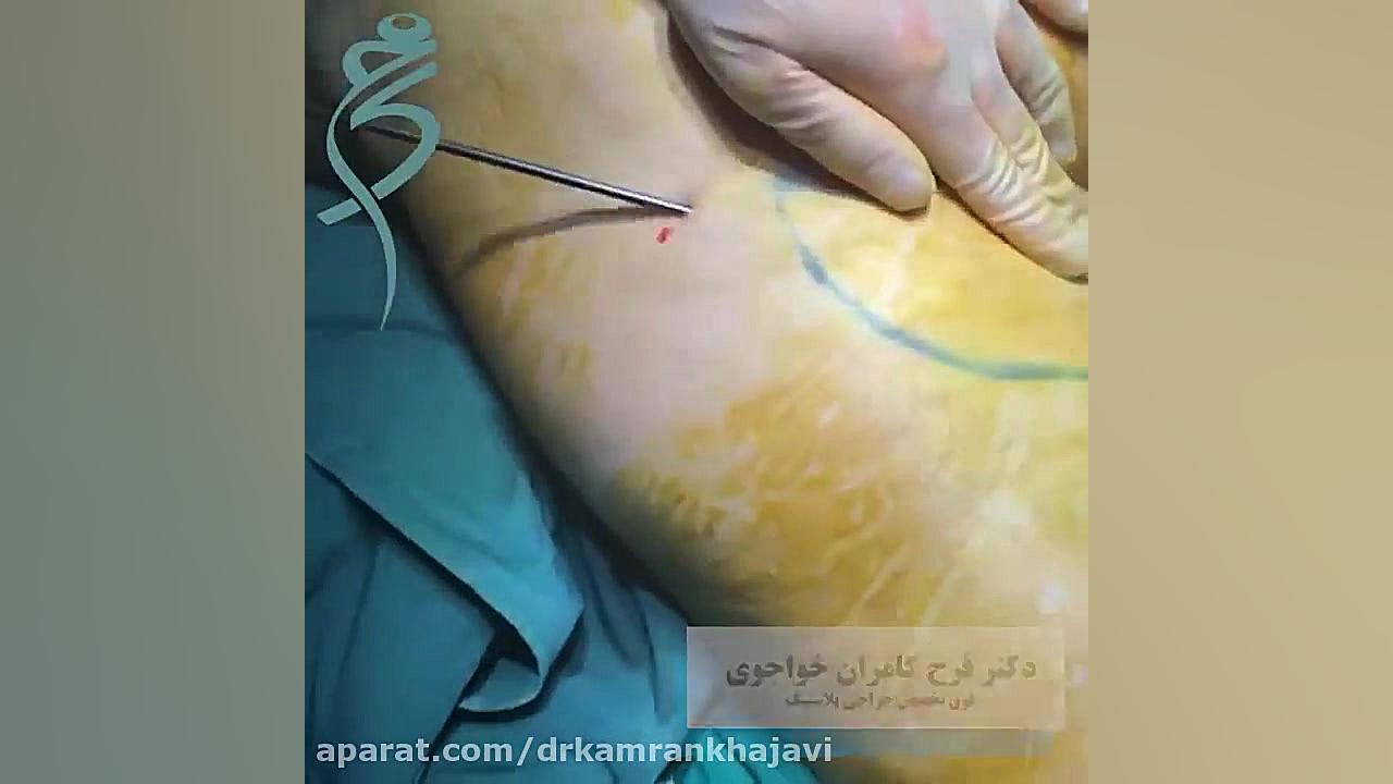 لیپوماتیک ساق ران دندانپزشک زیبایی