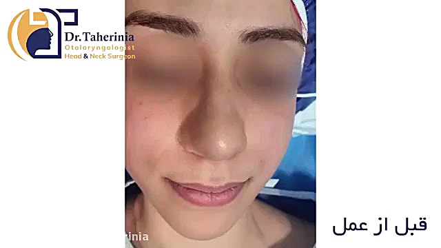 فیلم واقعی جراحی بینی گوشتی در اتاق عمل دندان مصنوعی