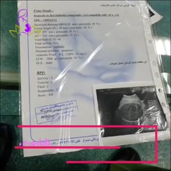 بارداری حاصل ivfدر خانمی با تخ...