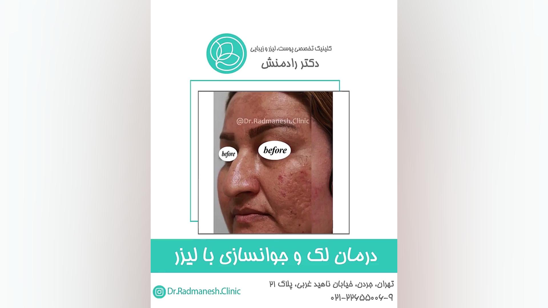درمان لک و جوانسازی با لیزر جراحی فک