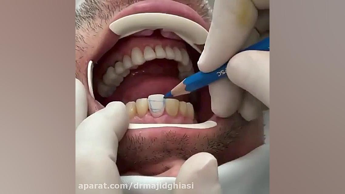 اصلاح طرح لبخند دکترمجیدقیاسی