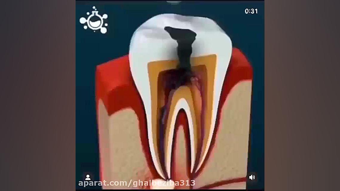 مراحل عصب کشی (اندو) و پُرکردن (ترمیم) دندان ترمیم دندان