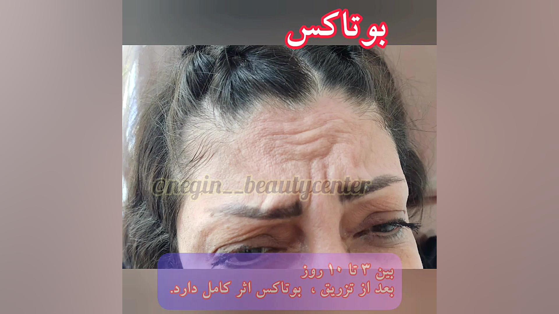 بوتاکس ایرانی و کره ای در گرگان گنبد کردکوی 09336093000 چالش موزیکال