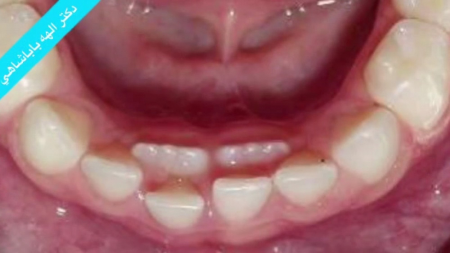 دندان کوسه ای در کودکان دکتر الهه باباشاهی | متخصص دندانپزشکی کودکان