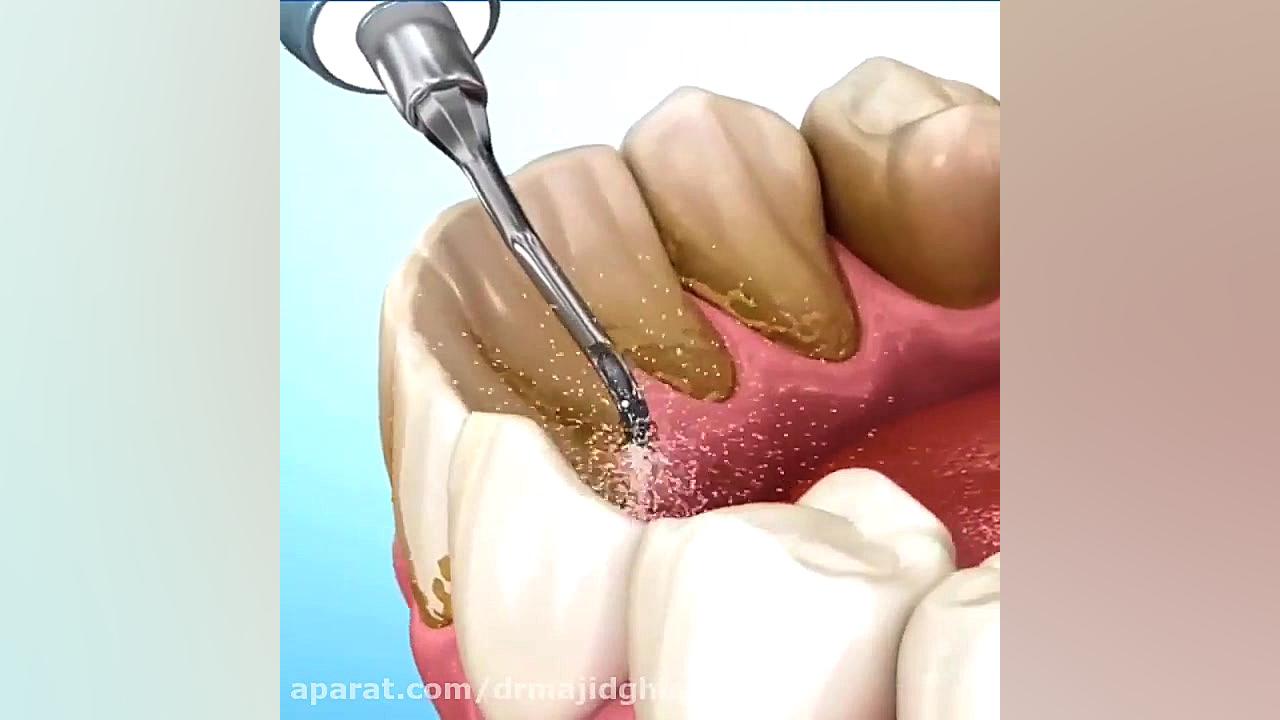 جرمگیری دندان دکترمجیدقیاسی