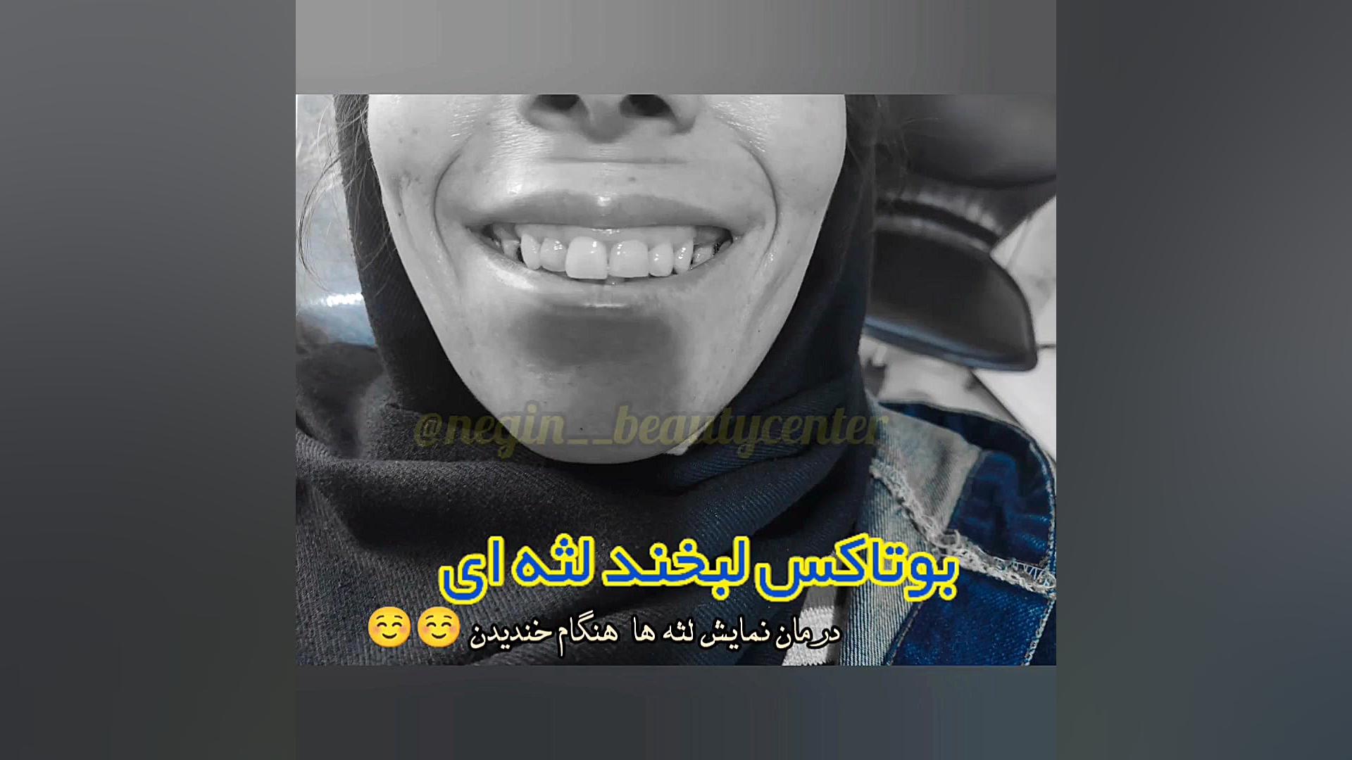 بوتاکس لبخند لثه ای در گرگان ۰۹۳۳۶۰۹۳۰۰۰ پر کردن دندان
