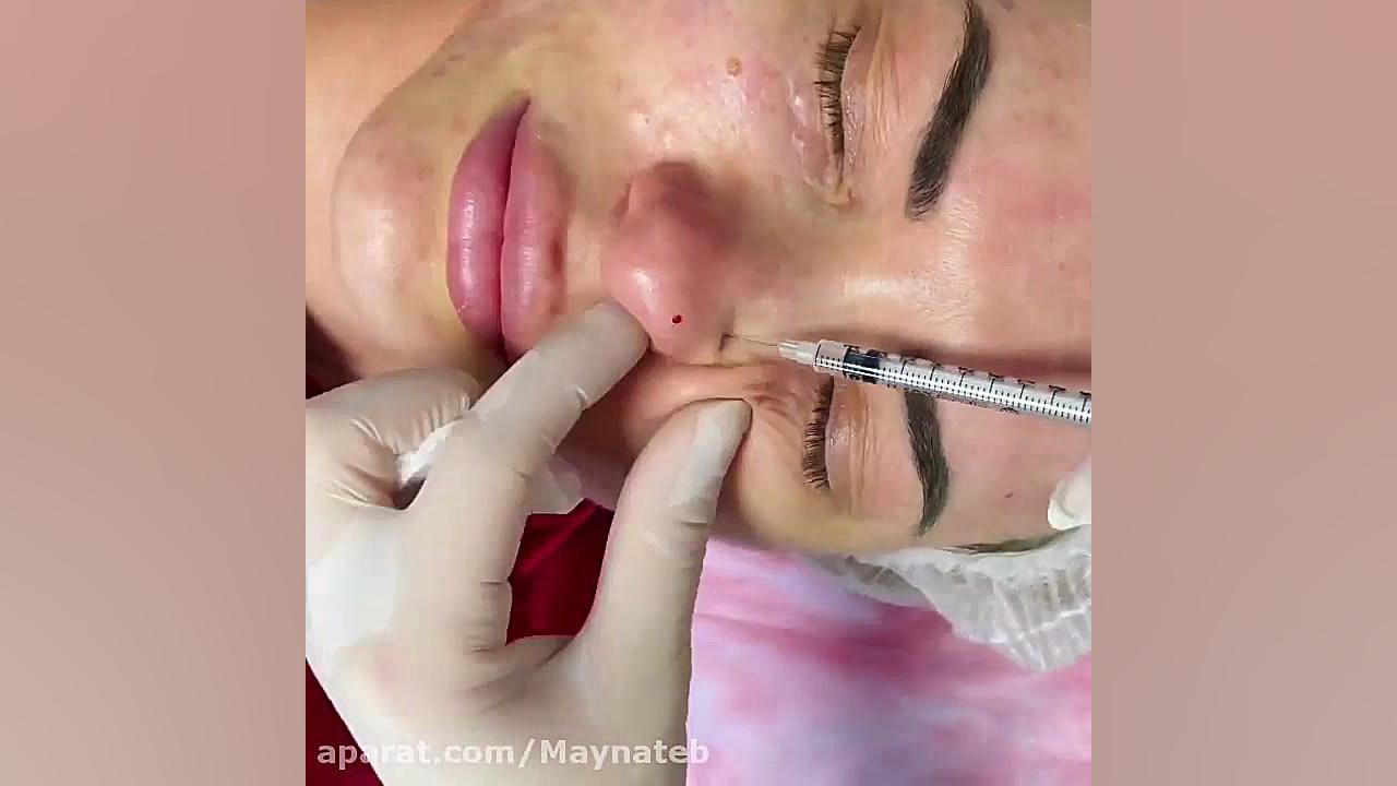 نحوه تزریق آنزیم بینی دستگاه فلوئورسنس تایم-لپس