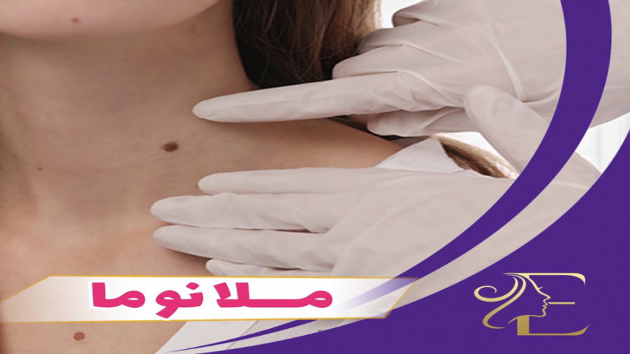 ملانوما کلینیک لیزر