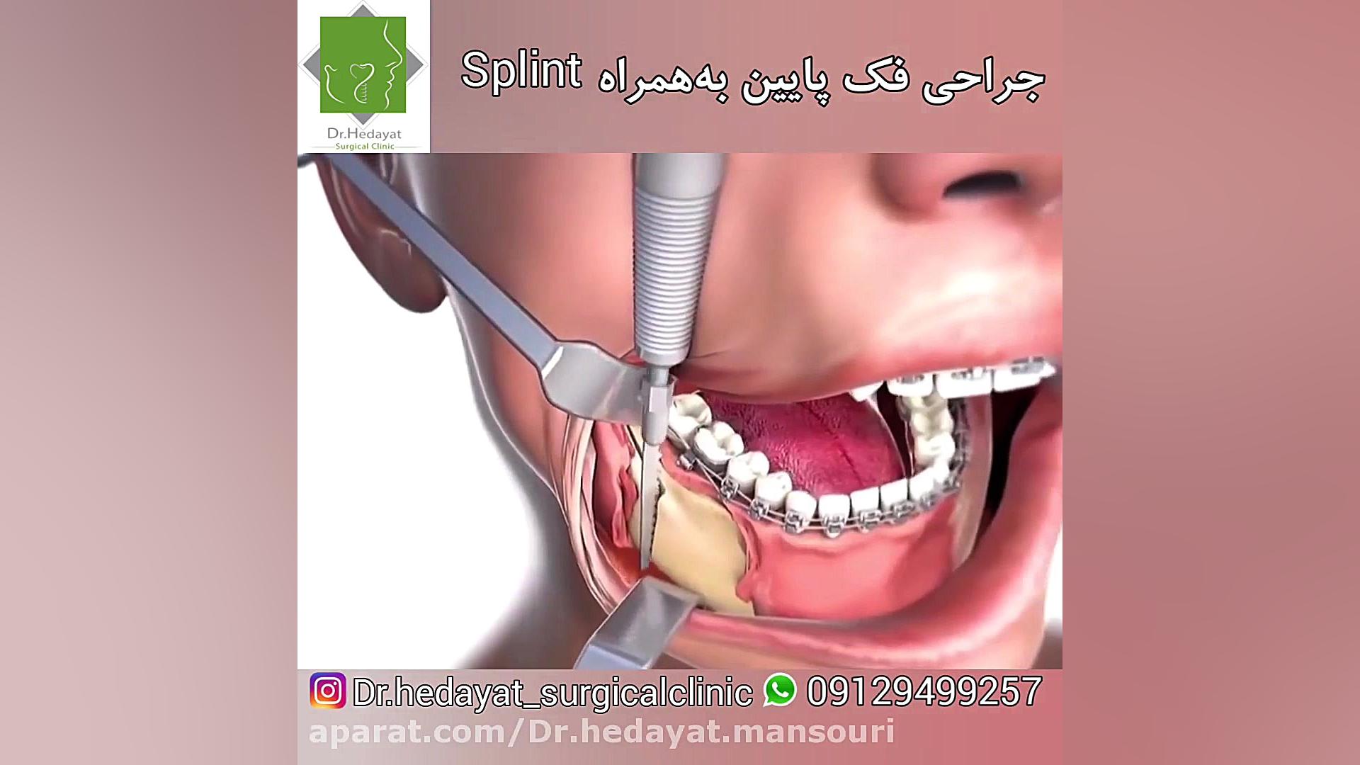 جراحي فك پايين بهمراه اسپلينت با دکتر هدایت منصوری لیپوماتیک