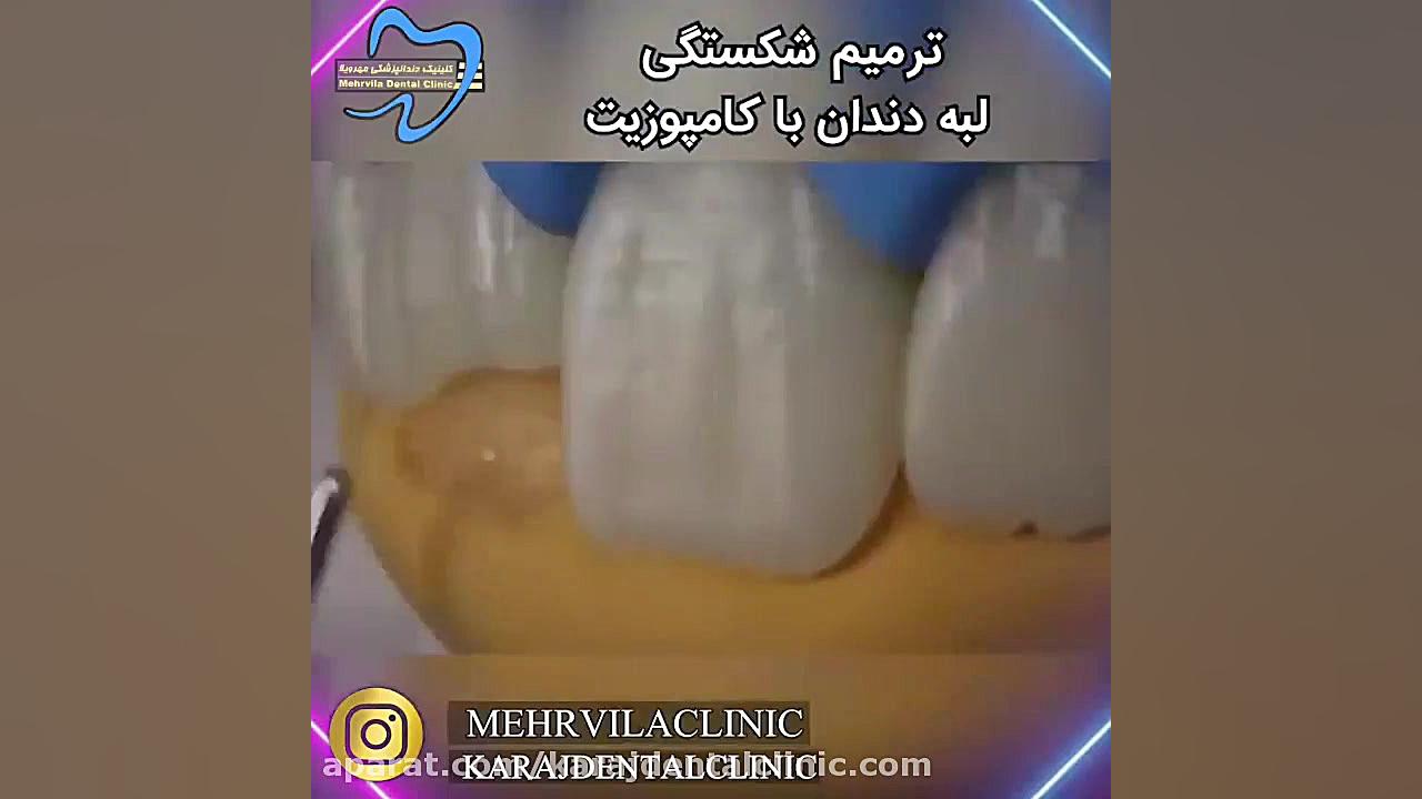 ترمیم شکستگی لبه دندان با کامپوزیت دندان پیش