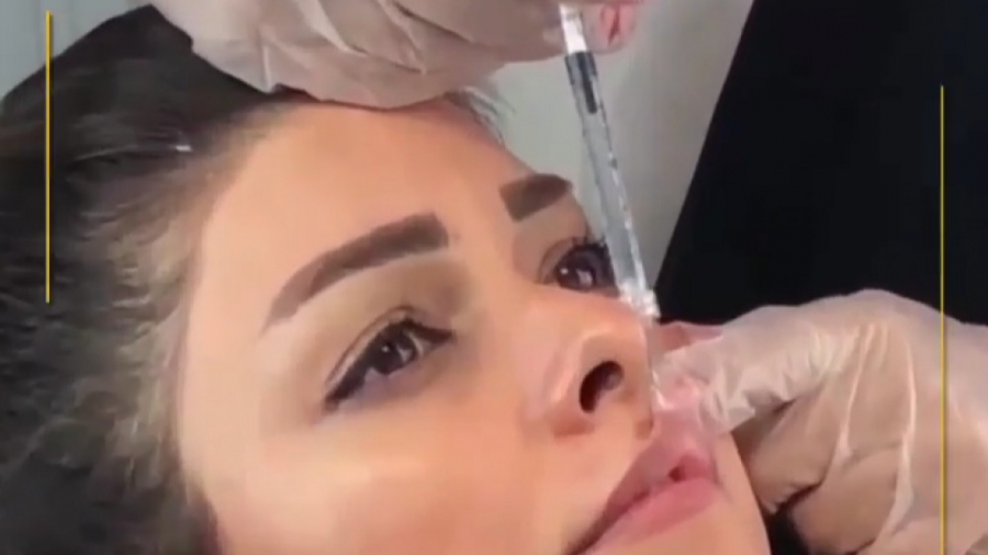 تزریق ژل لب روسی جراحی پف زیر چشم