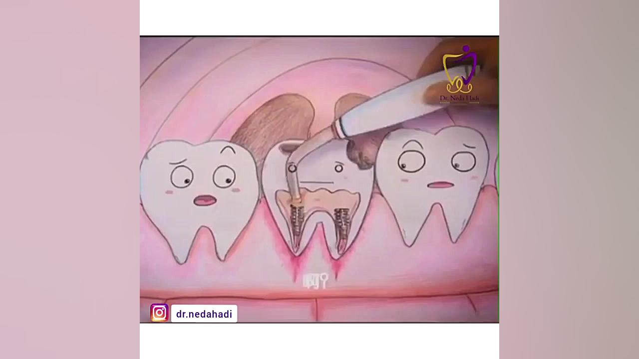 فیلم واقعی عصب کشی دندان دکتر ندا هادی-دندانپزشک زیبایی