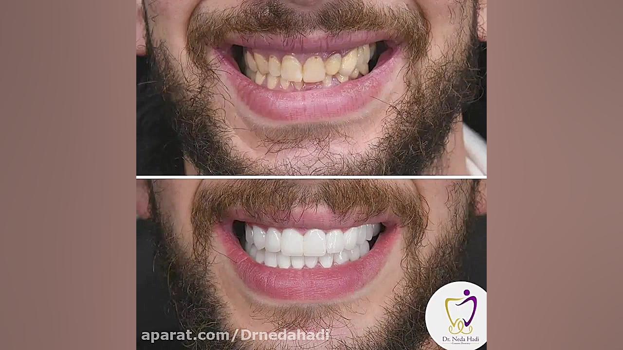فیلم واقعی کامپوزیت دندان دکتر ندا هادی-دندانپزشک زیبایی