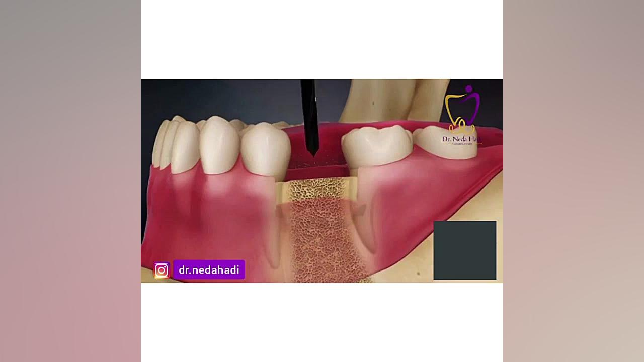 بازسازی ناحیه بی دندان دکتر ندا هادی-دندانپزشک زیبایی