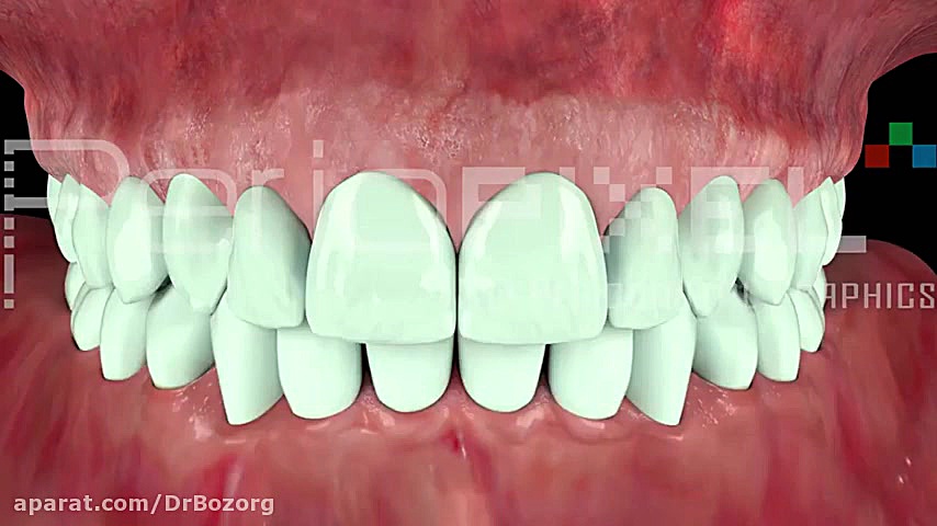 اصلاح لبخند لثه ای با لیزر تزریق چربی