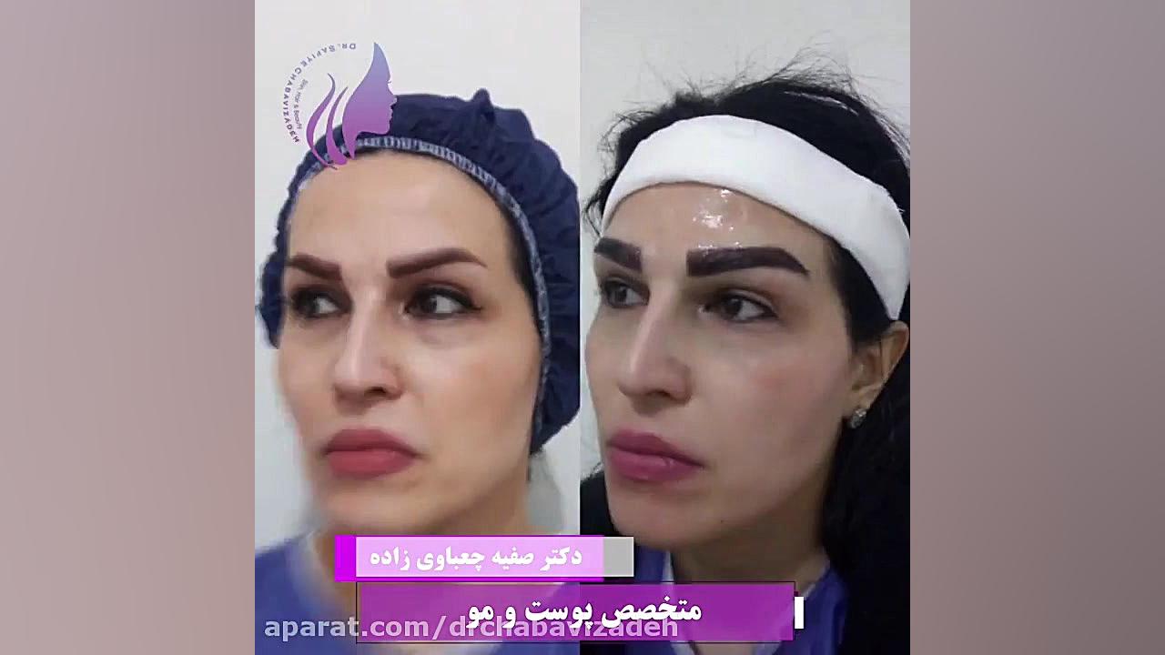 کاشت ابرو با تراکم بالا و پوشش تاتو دکتر صفیه چعباوی زاده