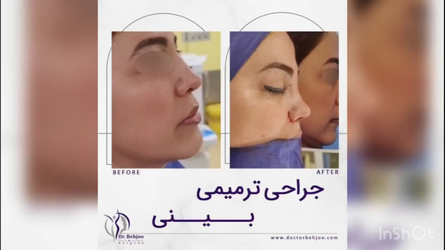 جراحی ترمیمی بینی دکتر شاهین بهجو - فوق تخصص جراحی پلاستیک