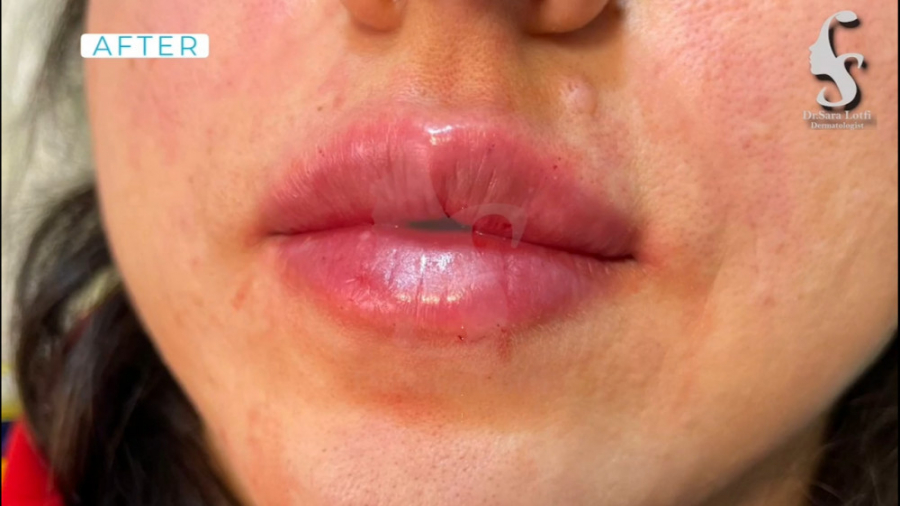 فلم تزریق فیلر لب دکتر سار ا لطفی