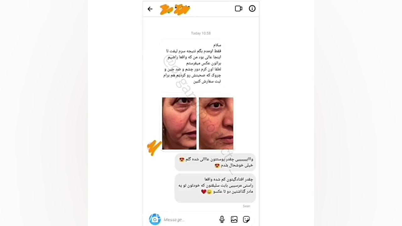 درمان چین و چروک و افتادگی صورت بوتاکس طبیعی پلاسماجت