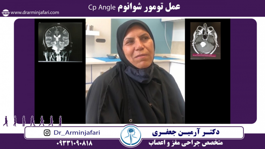 عمل تومور شوانوم Cp Angle روکش دندان