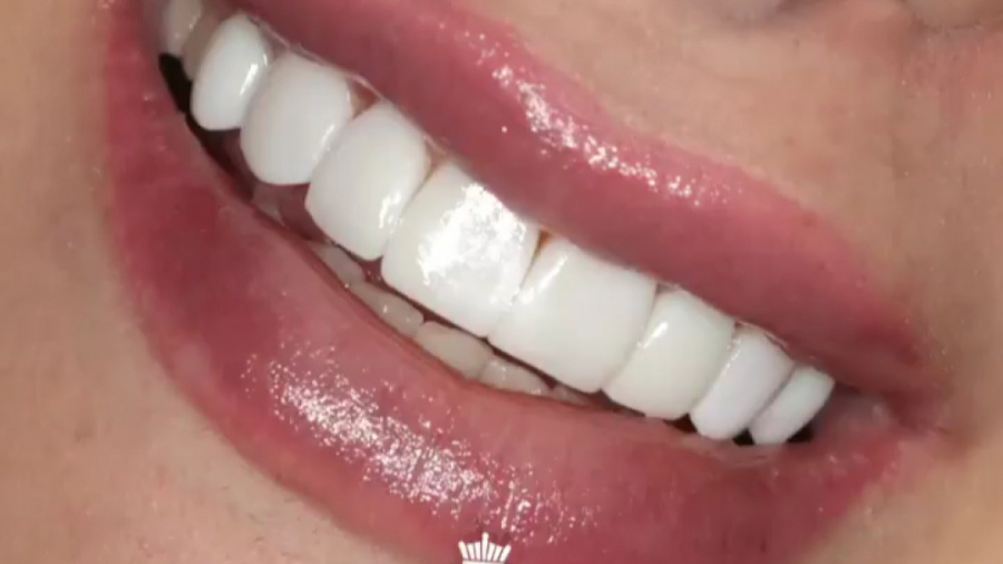 ریمو کردن کامپوزیت های قدیمی دکتر منصور بابایی